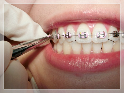 【高雄裝牙套診所推薦】到高雄牙齒矯正專科裝牙套評價比較!除了牙醫師很專業外,戴牙套的矯正器還是粉色的唷~女孩兒們都很推薦呀!