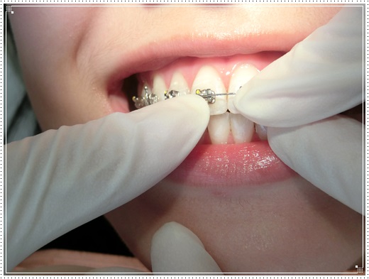 【牙醫診所】高雄牙齒診所的裝牙套矯正費用及專業牙醫師評論分享,牙醫矯正醫師動作好溫柔,價格也很合理呢!