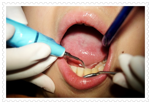 【牙齒冷光美白分享】台南牙醫診所的冷光牙齒美白很多人推薦!不只評論好價格也很公道唷~
