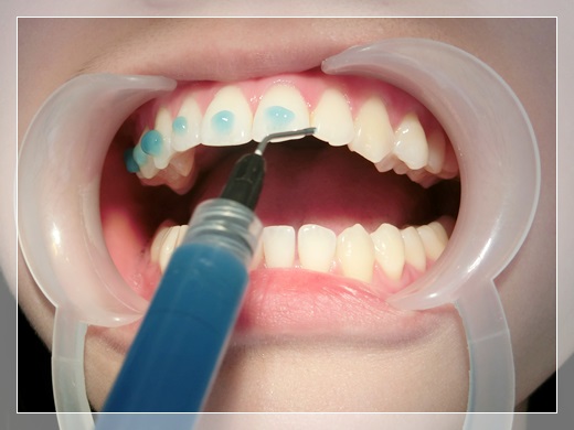 【台南裝牙套診所推薦】到台南牙齒矯正專科裝牙套評價比較!除了牙醫師很專業外,戴牙套的矯正器還是粉色的唷~女孩兒們都很推薦呀!