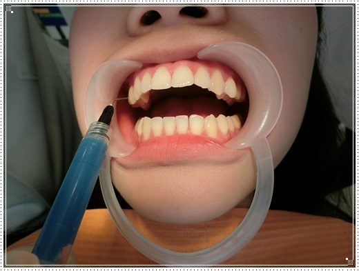 【牙醫診所】台南牙齒診所的裝牙套矯正費用及專業牙醫師評論分享,牙醫矯正醫師動作好溫柔,價格也很合理呢!