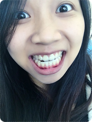 牙科矯正費用 台南牙科診所的牙齒矯正權威分享 找牙齒矯正專科裝牙套比較推薦 費用也相當合理呢 日記 分享 部落格