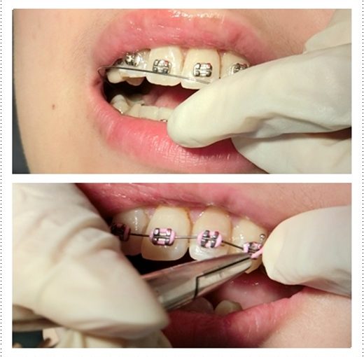 【台南牙科醫生】分享台南牙醫診所牙齒矯正權威及費用，裝牙套好專業又相當溫柔，好期待我整齊的牙齒阿～超推薦！