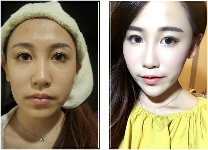 台南舒顏萃 音波拉皮及童顏針比較推薦到台南醫美診所 舒顏萃sculptra童顏針及極限音波拉皮都很專業 價錢也很公道 日記 分享 部落格