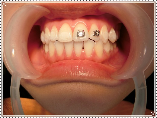 【台北牙齒矯正牙醫師】台北牙齒診所的裝牙套矯正費用及專業牙醫師分享,醫師動作好溫柔,粉色系的矯正器超可愛的!